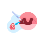 عمليات استئصال اللوزتين واللحمية