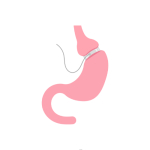 جراحة سمنة وتخسيس