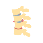 إزالة الانزلاق الغضروفي بالتدخل الميكروسكوبي المحدود