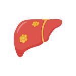 علاج اورام الكبد بالتردد الحرارى والميكروويف