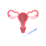 التلقيح الصناعي و الحقن المجهري