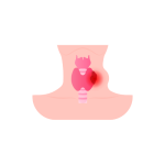 علاج ومتابعة حالات أورام الغده الدرقيه