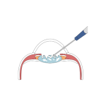 جراحات المياه البيضاء و جراحة القرنية