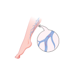 علاج قدم سكري و دوالي الساقين