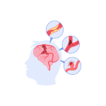 جراحة صمامات المخ و القسطرة المخية