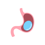 تركيب بالون المعدة للتخسيس