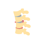 علاج الانزلاق الغضروفى بدون جراحة