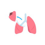 تشخيص و استئصال أورام الرئة