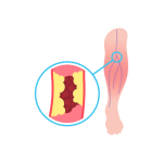 قسطرة العلاجية علي الشرايين الطرفية