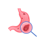 الإكتشاف المبكر للتقرحات و الاورام