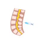 العلاج بالتردد الحرارى وحقن جذور الأعصاب