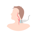 علاج امراض الشريان السباتي