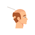 زراعه شعر الرأس والحاجبين