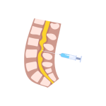 جراحة النخاع الشوكي