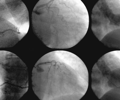 دليل شامل لتركيب القسطرة التشخيصية والعلاجية