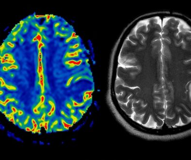 جراحة اورام المخ