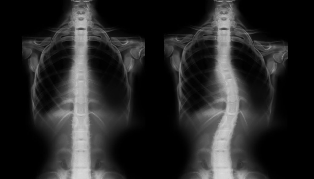 إصلاح تشوهات واعوجاج العمود الفقري الخلقية نصائح وتعليمات تثقيفية.