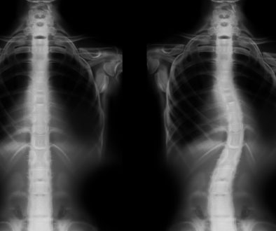 إصلاح تشوهات واعوجاج العمود الفقري الخلقية نصائح وتعليمات تثقيفية.