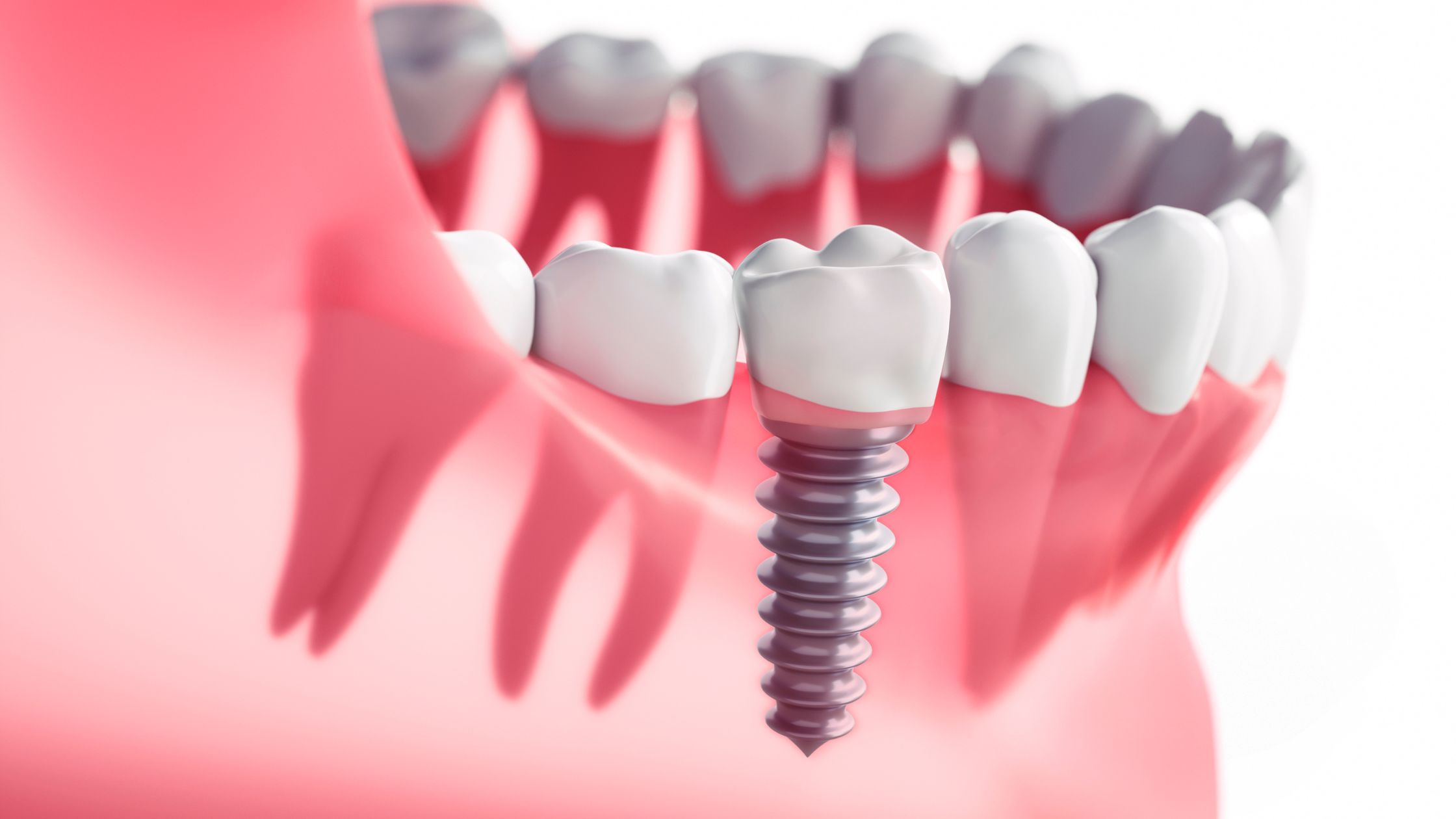 Dental Implant