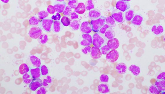 تشخيص و علاج سرطان الدم