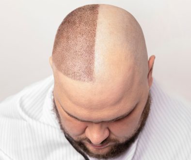 زراعة شعر الرأس والحاجبين