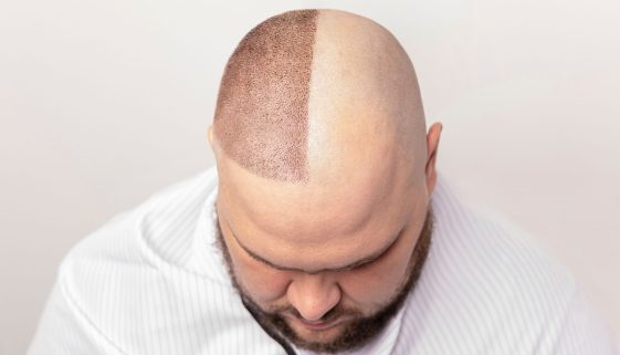 زراعة شعر الرأس والحاجبين