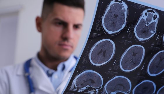 مرضى التصلّب المتعدد