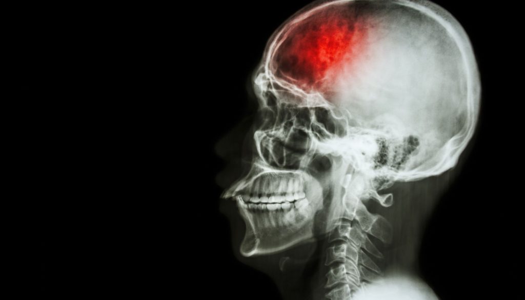 العناية بالسكتة الدماغية