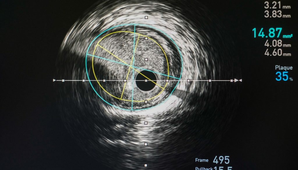 القسطرة-العلاجية-علي-الشرايين-الطرفية