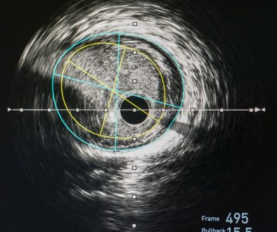 القسطرة-العلاجية-علي-الشرايين-الطرفية
