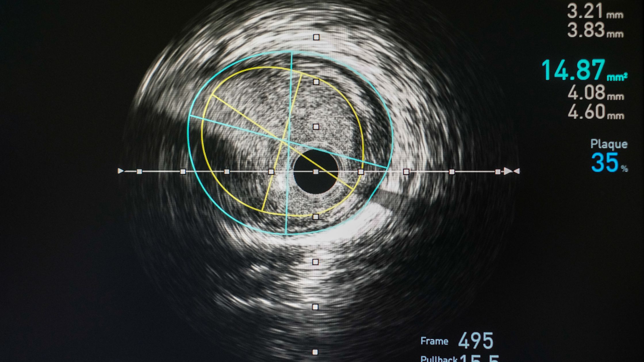 القسطرة-العلاجية-علي-الشرايين-الطرفية