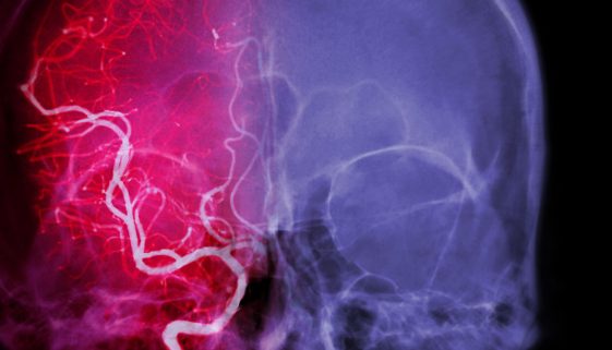 علاج حالات نزيف المخ