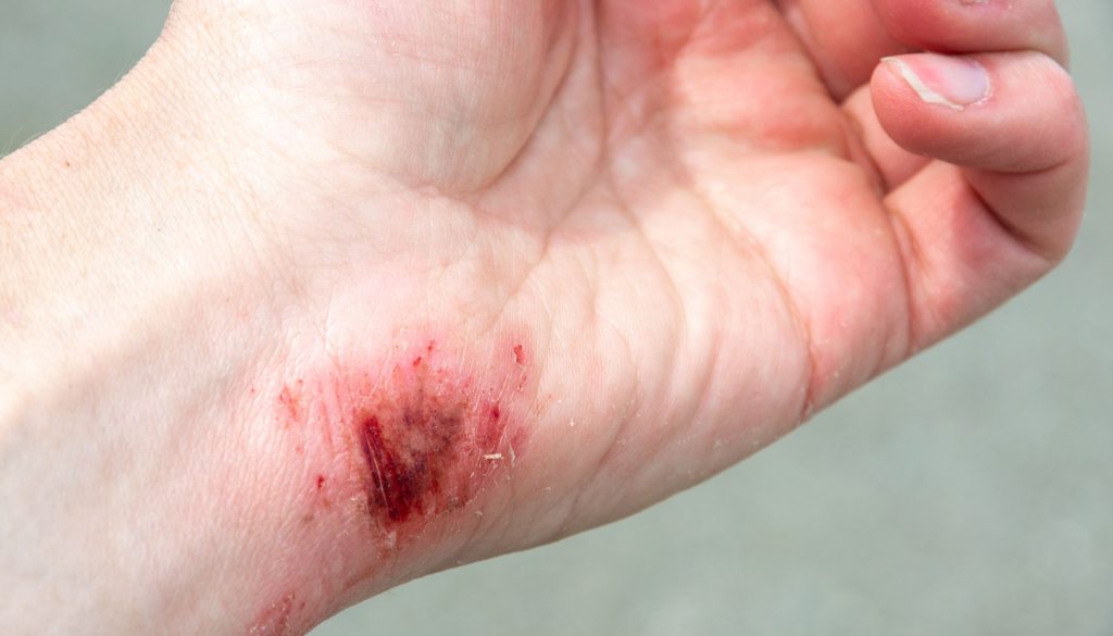 Treatment of burns and wounds