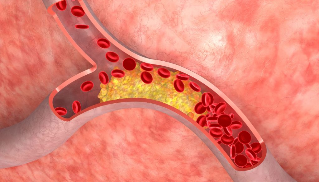 علاج إرتفاع نسبة الدهون بالدم والكوليسترول
