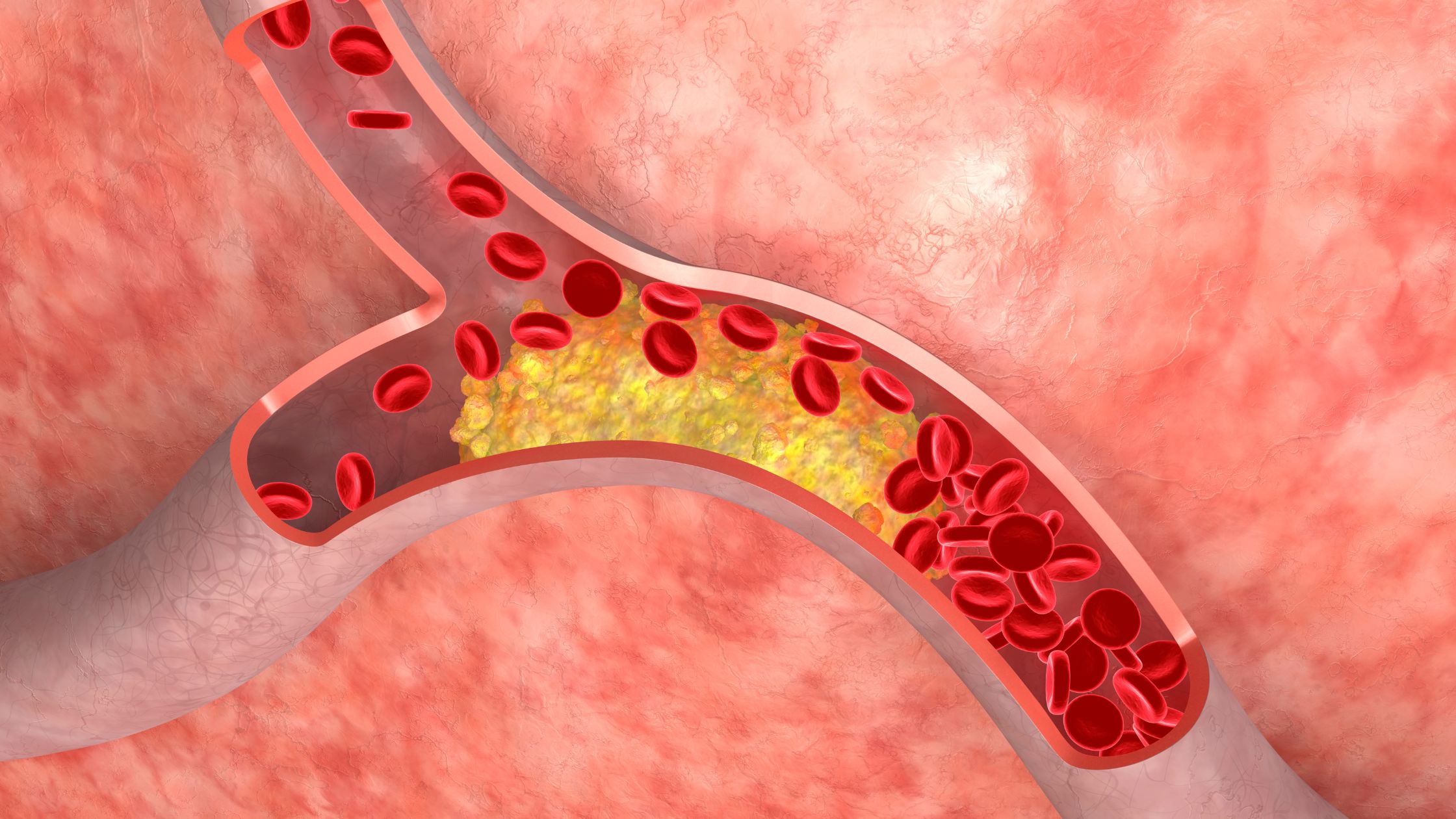 علاج إرتفاع نسبة الدهون بالدم والكوليسترول