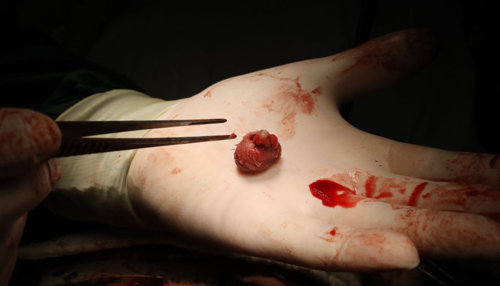 جراحات الأورام