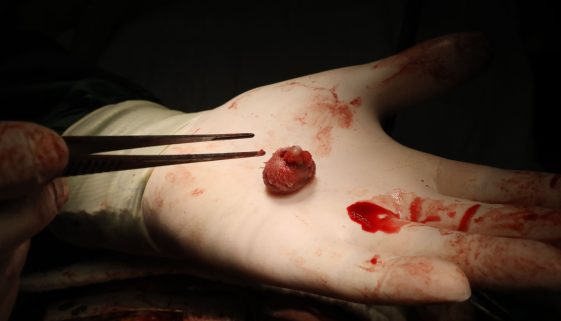 جراحات الأورام