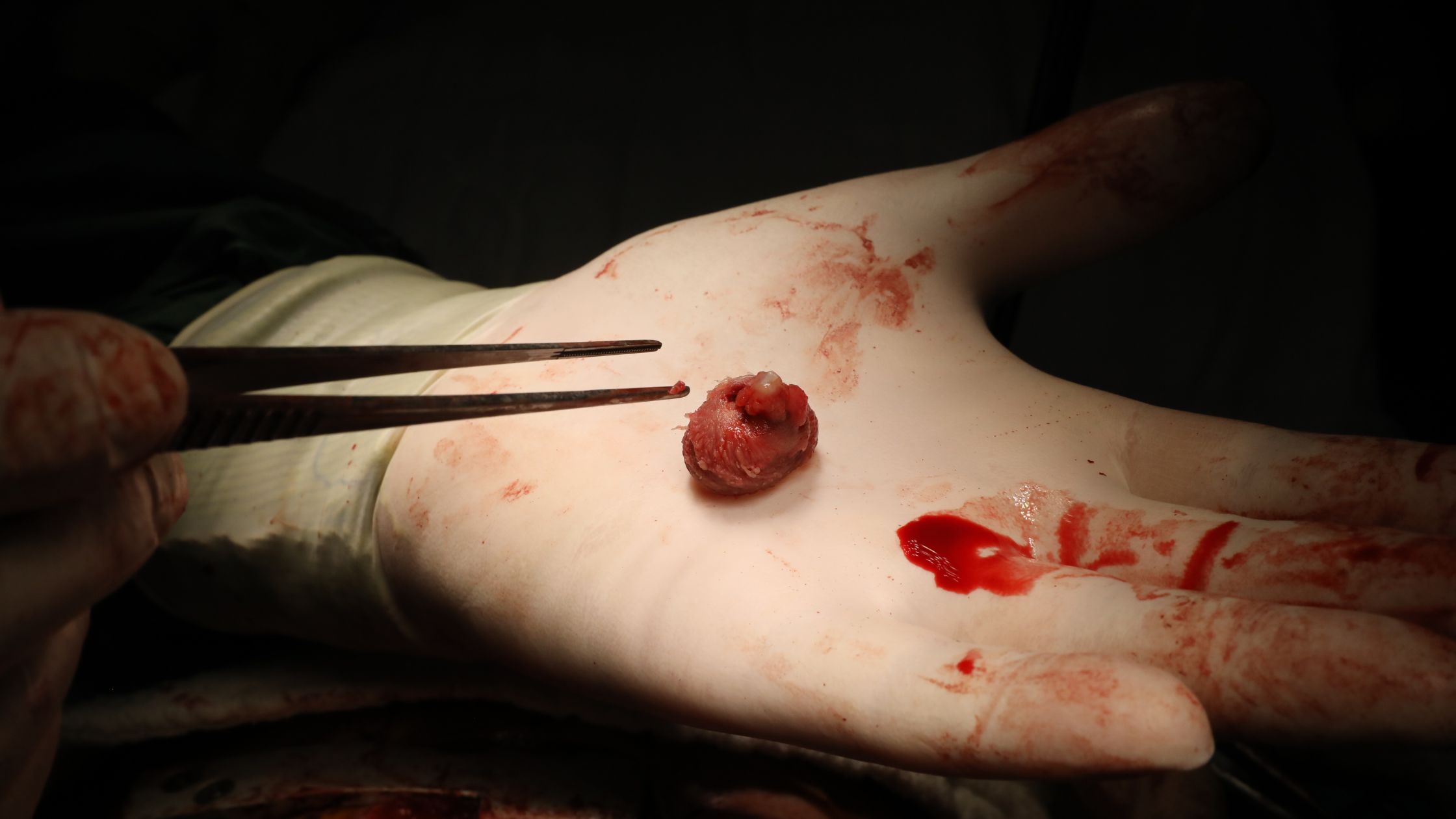 جراحات الأورام