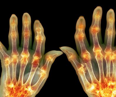 مرض الروماتويد المفصلي