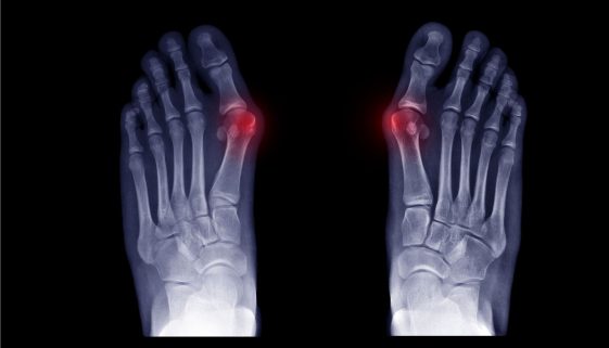 علاج تشوهات العظام